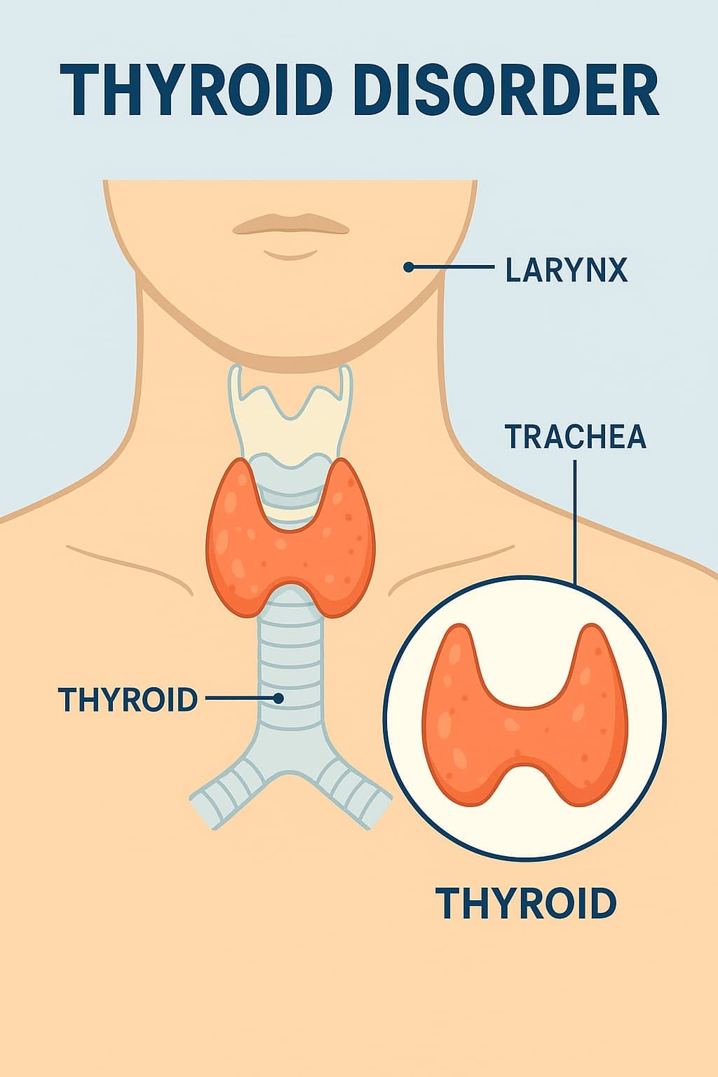 Medical illustration of thyroid gland showing nodules and treatment options, representing how thyroid disorders affect life insurance approval.